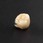 металлокерамика в стоматологии